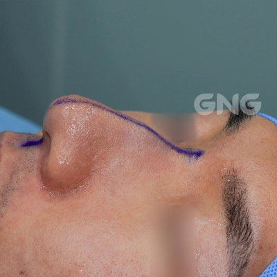기능코수술, 3일 이상 코막힘이 있다면 의심하세요