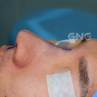 기능코수술, 3일 이상 코막힘이 있다면 의심하세요 사진 2