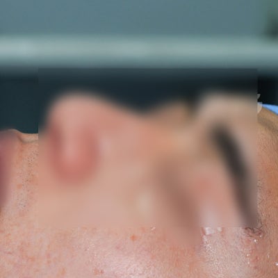 비염수술코성형, 병원급 의료기관 지앤지병원에서