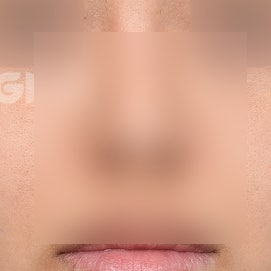 무보형물코성형 비용, 보형물 수술과의 차이 사진 2
