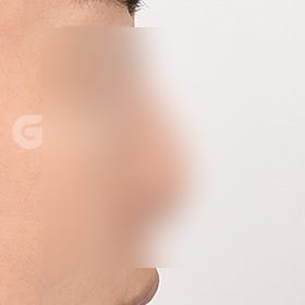 무보형물코성형 비용, 보형물 수술과의 차이