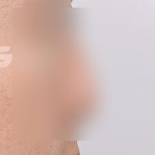 늑연골코수술 비용은? 자가조직의 장점 사진 5
