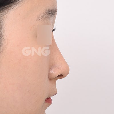 무보형물코성형 비용과 수술 방법 상세 가이드 사진 12