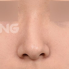 무보형물코성형 비용과 수술 방법 상세 가이드 사진 5