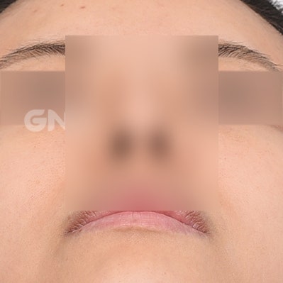 자가늑코수술 비용과 선택 기준은? 사진 4