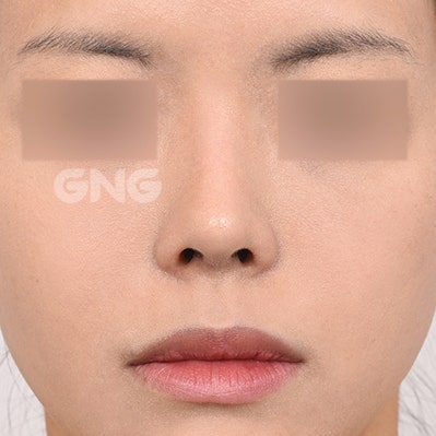 자가늑코수술 비용과 선택 기준은? 사진 8