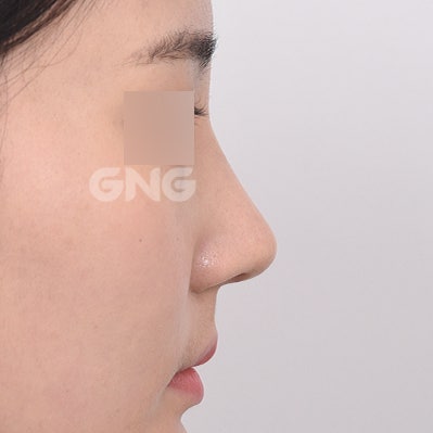 매부리코교정 수술 방법, 절개 vs 노플란트 코연골주사 사진 9