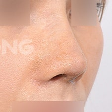 코재수술비용 병원별 차이 비교분석 사진 6