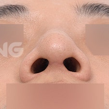 한쪽코막힘 원인과 해결법 3가지 사진 8