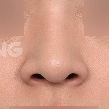 한쪽코막힘 원인과 해결법 3가지 사진 6
