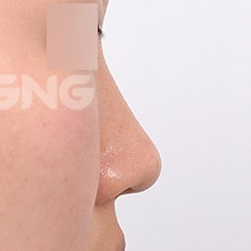 비염수술코성형 동시에 가능할까요? 사진 5