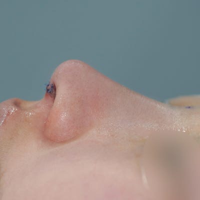 비염수술코성형 동시에 가능할까요? 사진 2