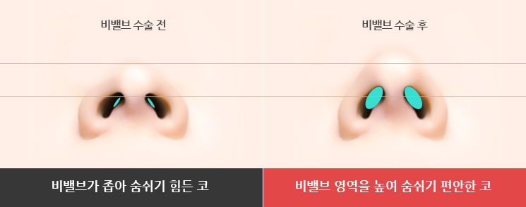 코뼈 휨 비중격까지 틀어졌다면 보험 적용될까 사진 3