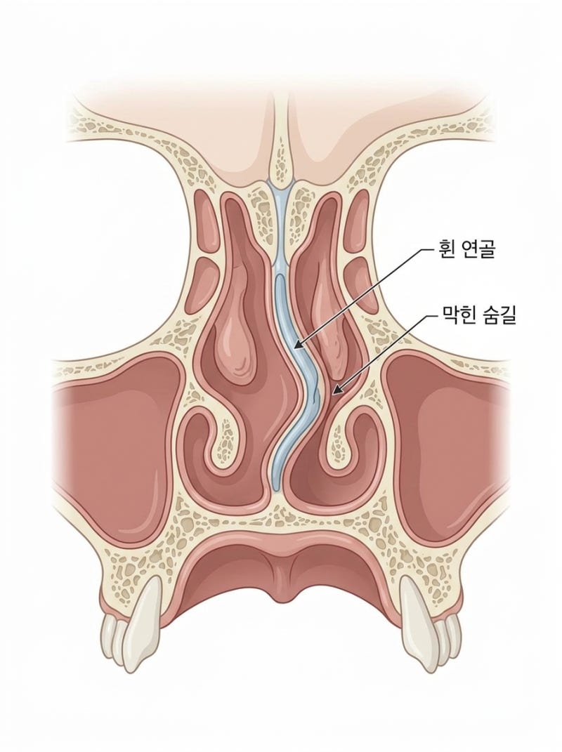 코뼈 휨 비중격까지 틀어졌다면 보험 적용될까 사진 2