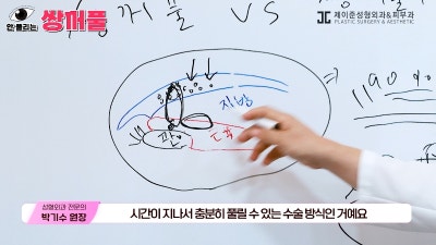 [제이준성형외과·피부과] 쌍꺼풀 수술 vs 쌍꺼풀+눈매교정! 눈매교정 함께 하면 좋은 이유! 사진 5