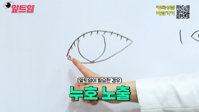 [제이준성형외과·피부과] 앞트임, 왜 필요할까? 앞트임의 모든 것!! 사진 17