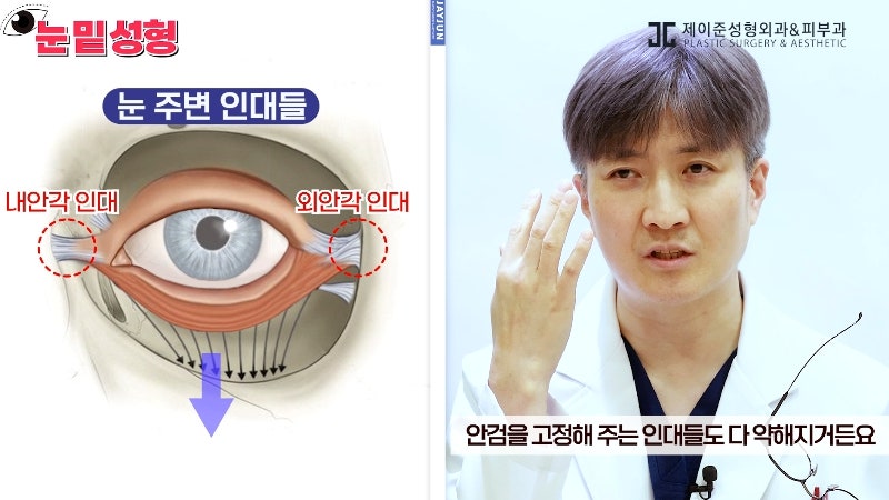 [제이준성형외과·피부과] 하안검? 눈밑지방재배치? 이것만 보고 결정하세요! 사진 6