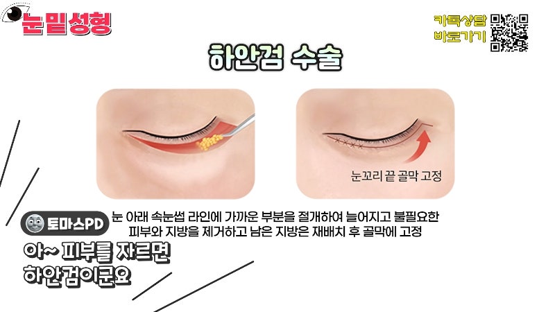[제이준성형외과·피부과] 하안검? 눈밑지방재배치? 이것만 보고 결정하세요! 사진 10