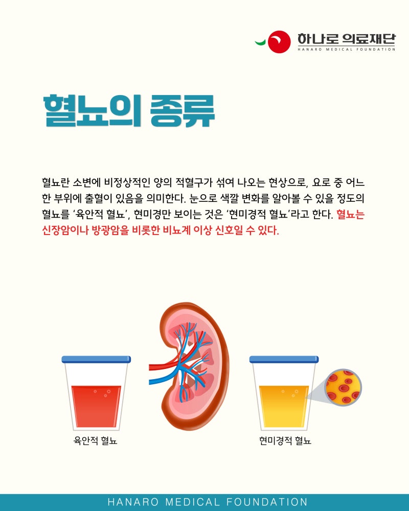 강남비뇨기과 남성 혈뇨 원인 방광암일까
