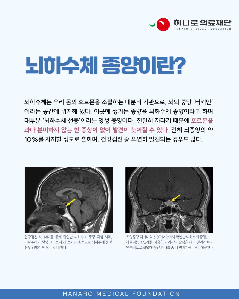Pituitary Tumors: Common Yet Often Overlooked