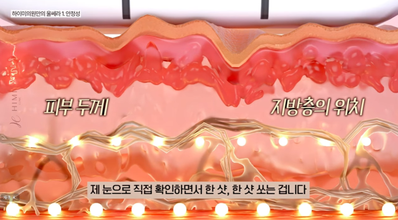 울쎄라 볼패임 걱정된다면? 얼굴살 적은 분들이 꼭 확인해야 할 것 사진 6