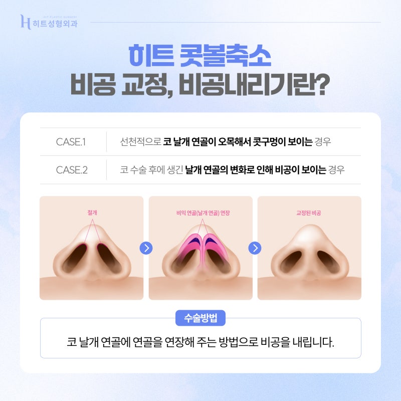 [히트성형외과] 콧볼축소의 모든 것! 비익거상과 비공내리기