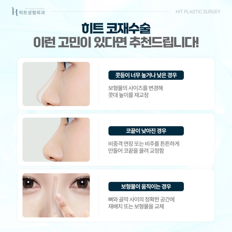 [히트성형외과] 아름다움과 기능까지, 만족스러운 코재수술 사진 4