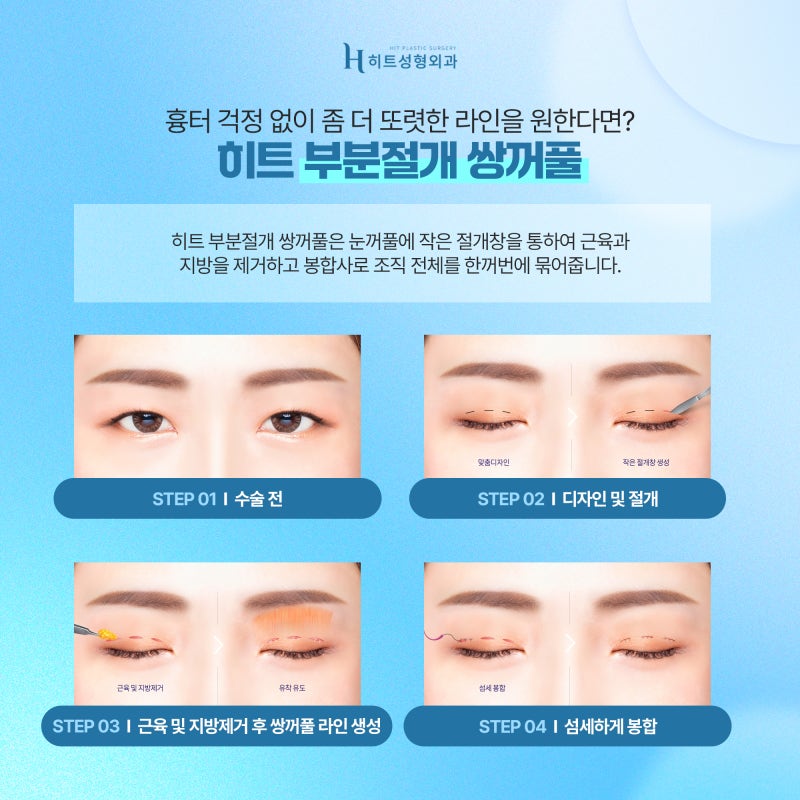 [히트성형외과] 나에게 맞는 쌍꺼풀 수술법은 뭘까 궁금하다면? 사진 3
