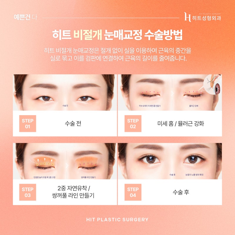 [히트성형외과] 작고 흐릿한 눈매, 히트 눈매교정으로 더 또렷하게 사진 3