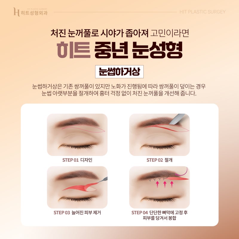 [히트성형외과] 중년 눈성형이 중요한 이유 사진 5