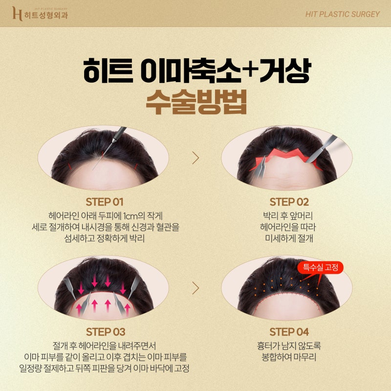 [히트성형외과] 넓은이마 개선방법, 히트 이마축소 사진 5