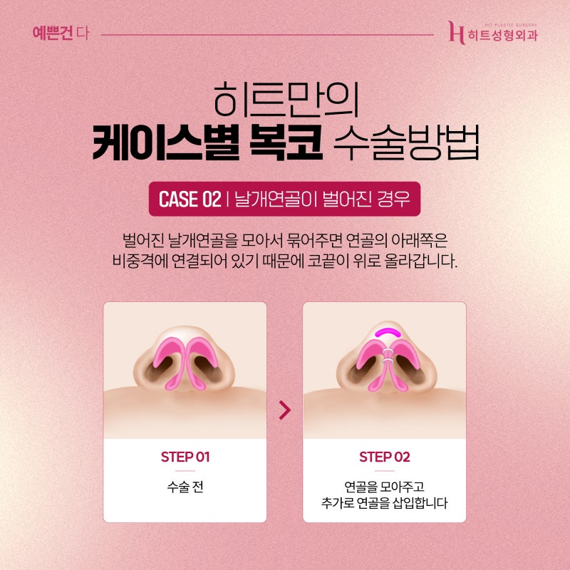 [히트성형외과] 복코 성형, 슬림하면서 더 오똑하게 사진 4