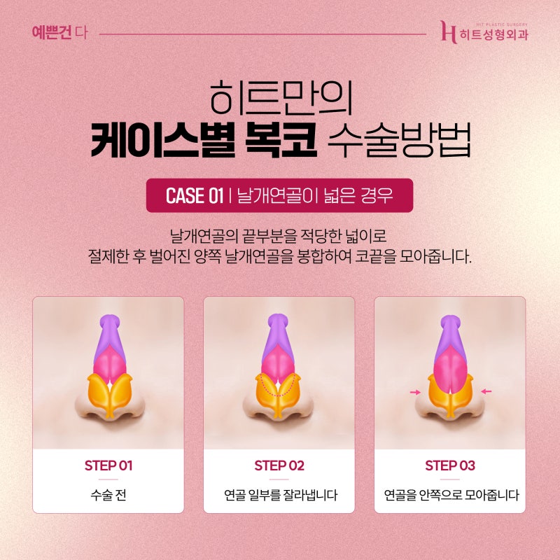 [히트성형외과] 복코 성형, 슬림하면서 더 오똑하게 사진 3