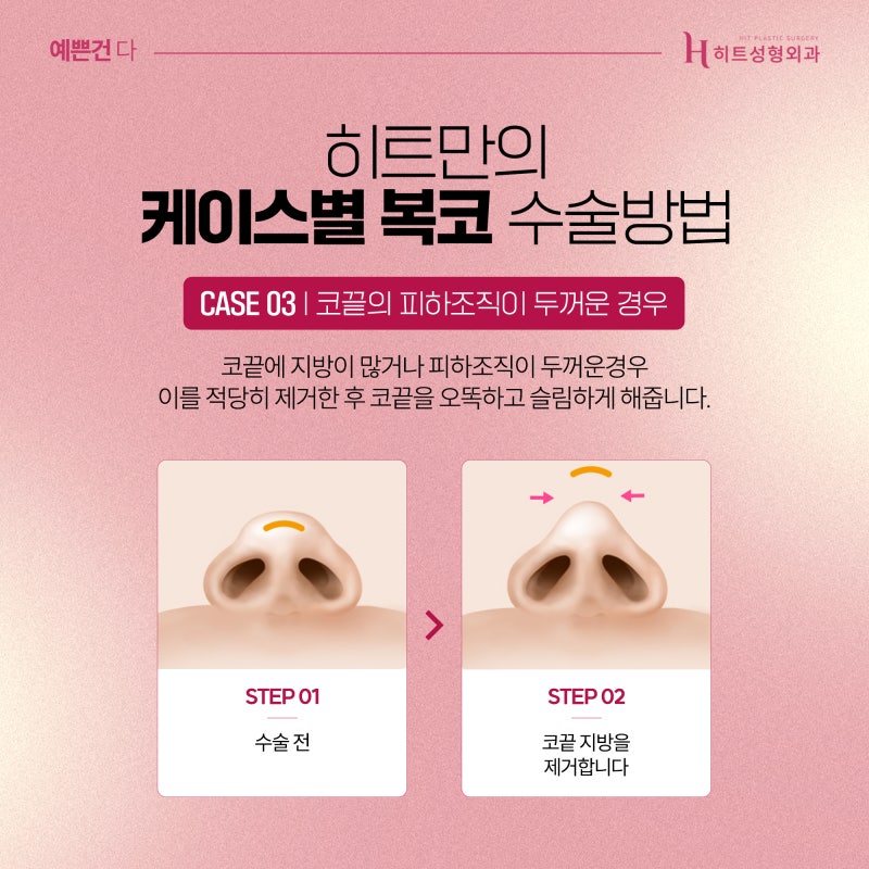 [히트성형외과] 복코 성형, 슬림하면서 더 오똑하게 사진 5