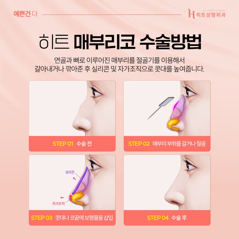 [히트성형외과] 부드러운 인상을 위한 매부리코 성형 사진 3