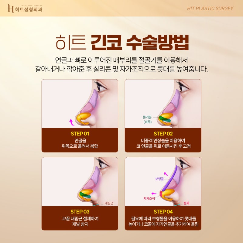 [히트성형외과] 중안부가 길어보인다면? 히트 긴코 성형 사진 3