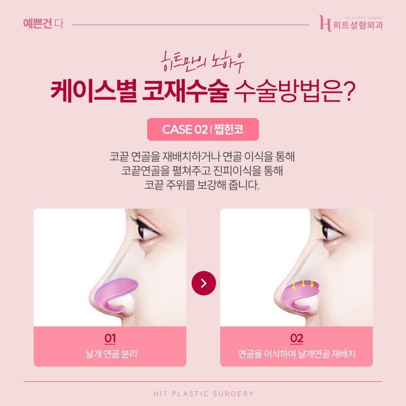 [히트성형외과] 오직 나를 위한 맞춤 보형물, 3D프린팅 코재수술 사진 4