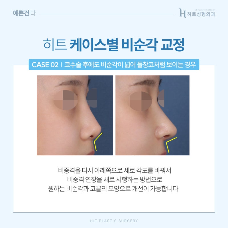 [히트성형외과] 이상적인 코 라인을 위한 히트 비순각 교정 사진 4