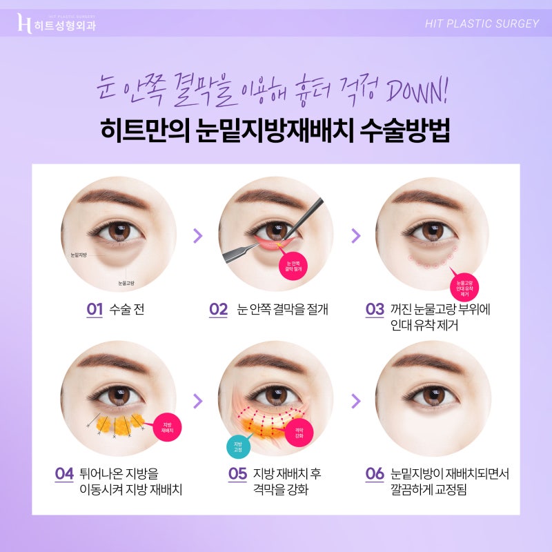 [히트성형외과] 어둡고 칙칙한 눈매 개선법, 히트 눈밑지방재배치 사진 4