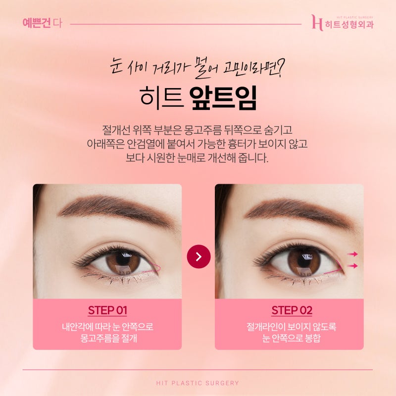 [히트성형외과] 트임 성형, 보다 더 시원한 눈매로 사진 2