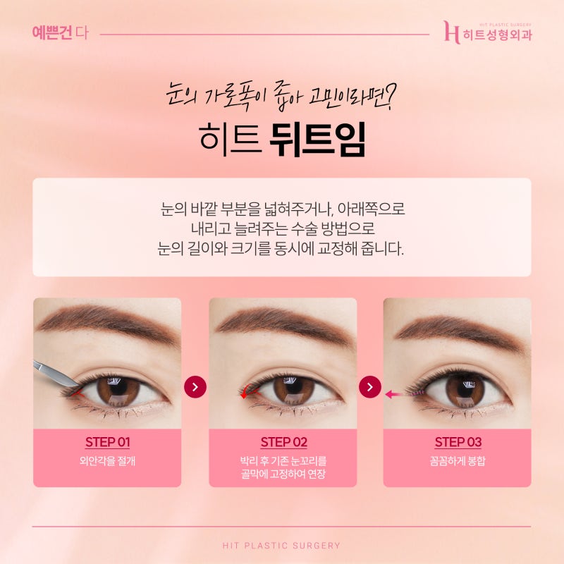 [히트성형외과] 트임 성형, 보다 더 시원한 눈매로 사진 4