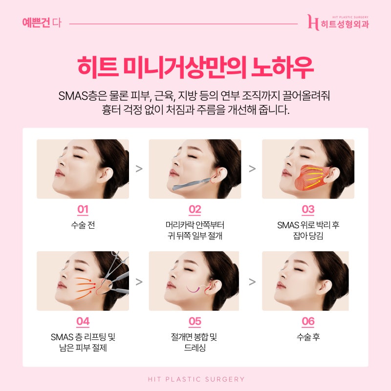 [히트성형외과] 확실한 리프팅 효과를 원한다면? 히트 미니거상 사진 4