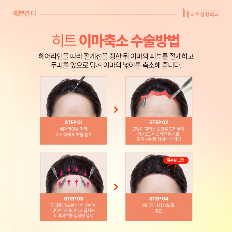 [히트성형외과] 이마축소, 조화로운 얼굴 밸런스를 원한다면 사진 4