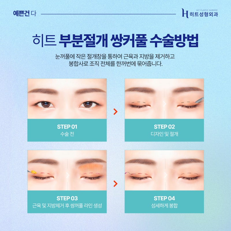 [히트성형외과] 히트 부분절개 쌍꺼풀 잘 풀리지 않는 시원한 라인으로! 사진 4