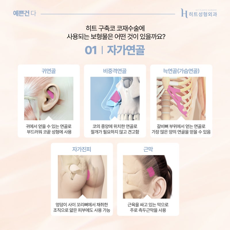 [히트성형외과] 구축코, 3D 맞춤보형물로 완성도 높은 코재수술! 사진 4