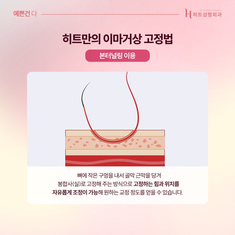 [히트성형외과] 이마거상 어떤 고정법이 나에게 맞을까? 사진 3