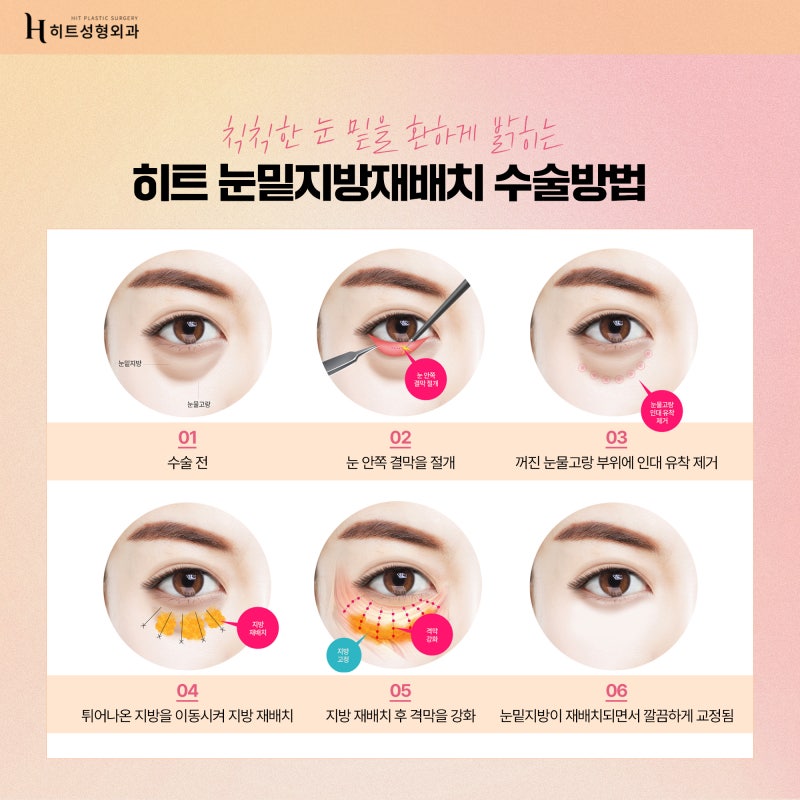 [히트성형외과] 피곤해 보이는 눈매라면? 눈밑지방재배치! 사진 4