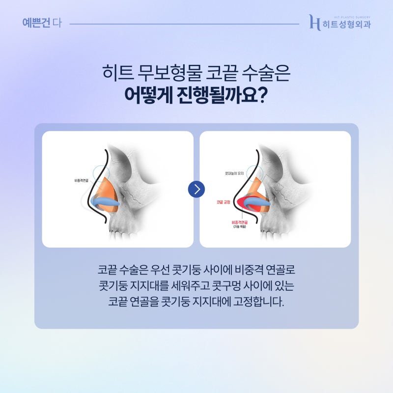 [히트성형외과] 자가조직만으로 세련되게! 무보형물 코끝 수술 사진 4