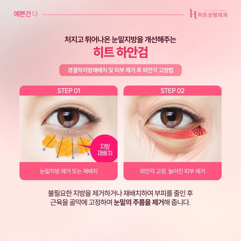 [히트성형외과] 눈성형, 연령대별로 알아보자! 사진 5