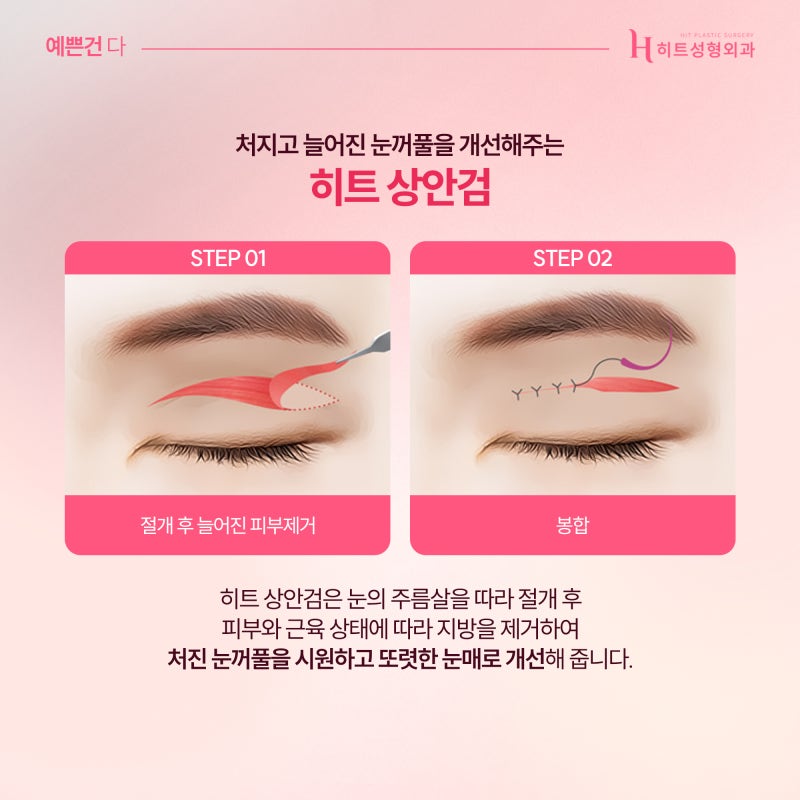 [히트성형외과] 눈성형, 연령대별로 알아보자! 사진 4